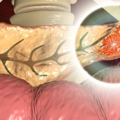 Tumore del pancreas, fate attenzione a questo campanello d’allarme