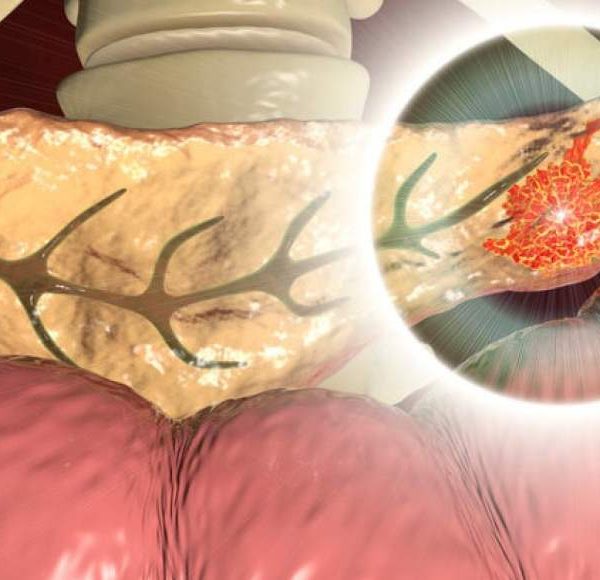 Tumore del pancreas, fate attenzione a questo campanello d’allarme