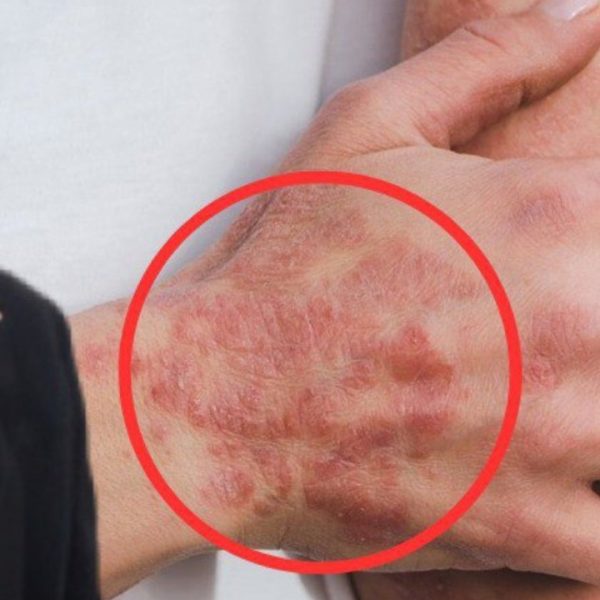 Una malattia che colpisce 500mila persone