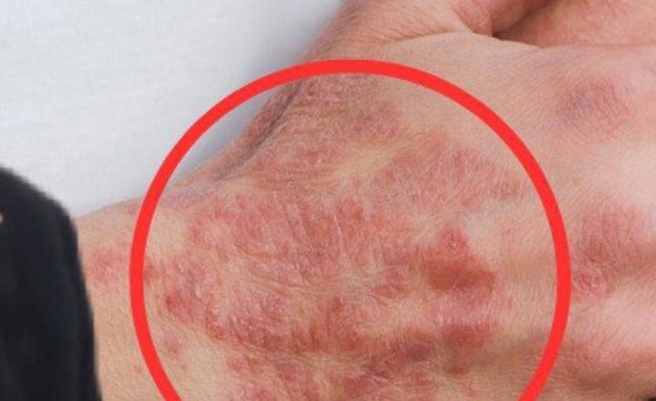 Una malattia che colpisce 500mila persone