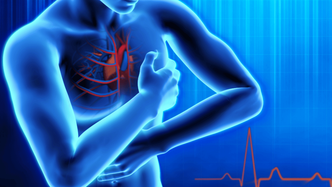 infarto