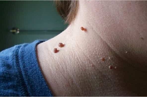 aceto-di-mele-fibromi