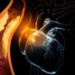 7 segnali che indicano le arterie ostruite. I sintomi da non sottovalutare mai