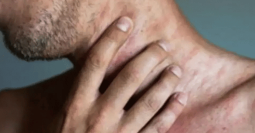 Sindrome alfa-gal, primo caso mortale negli USA: uomo muore dopo un barbecue