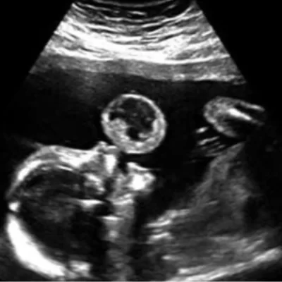 “Mia figlia fa le bolle”. Vede l’ecografia e scoppia a ridere, ma il medico la gela: scoperta choc