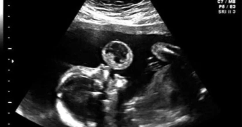 “Mia figlia fa le bolle”. Vede l’ecografia e scoppia a ridere, ma il medico la gela: scoperta choc