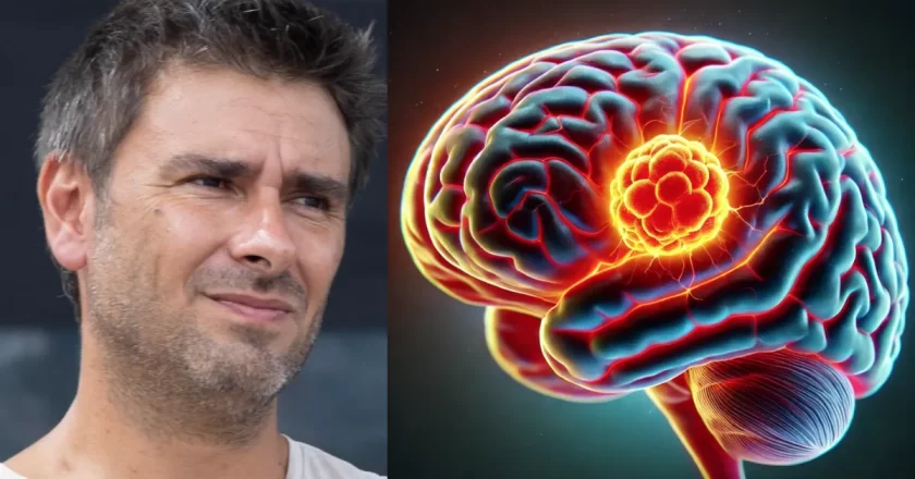 Di Battista, cosa indica un mal di testa forte e improvviso: l’analisi del neurologo Barbanti sulla cefalea a rombo di tuono